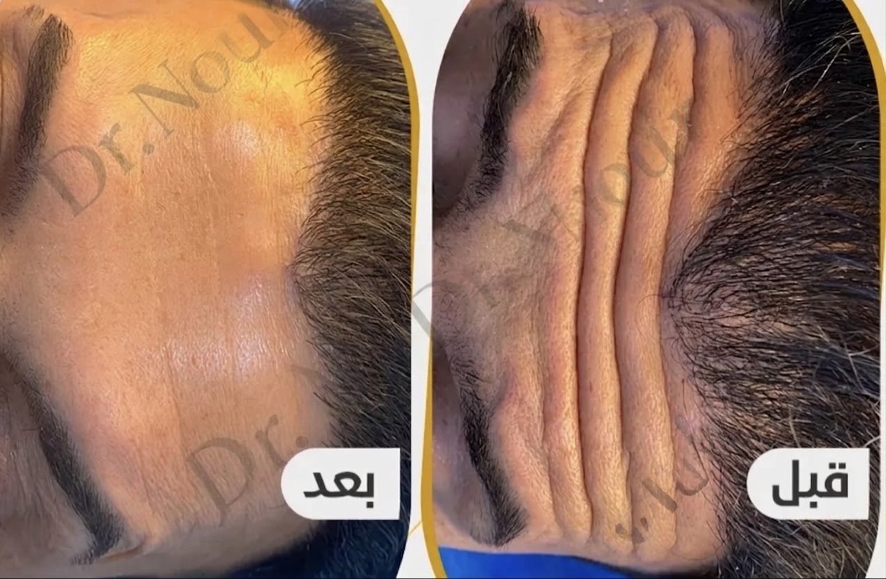 Vorher Nachher — Stirnfalten, Dr. Nour