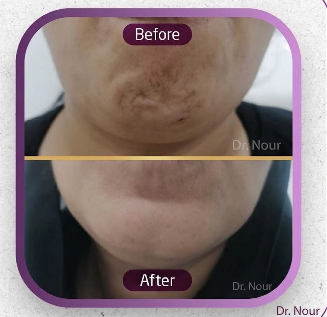Vorher Nachher — Hals & Kinn, Dr. Nour
