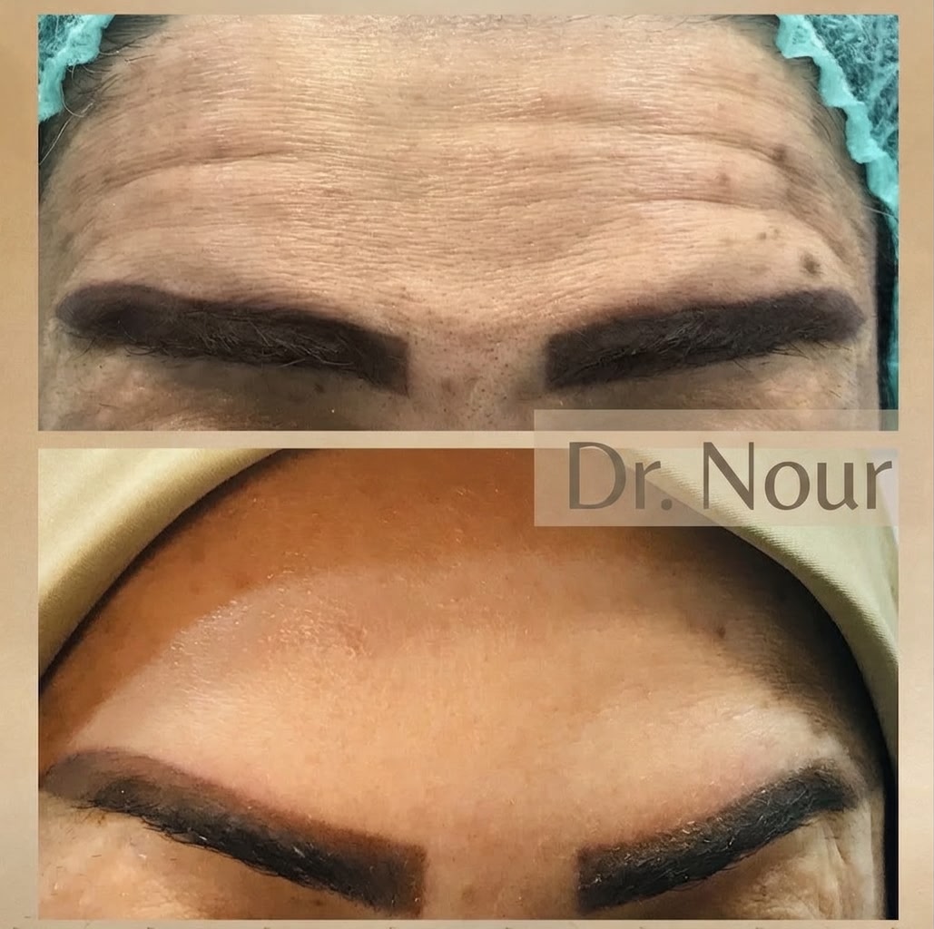 Vorher Nachher — Stirnfalten, Dr. Nour