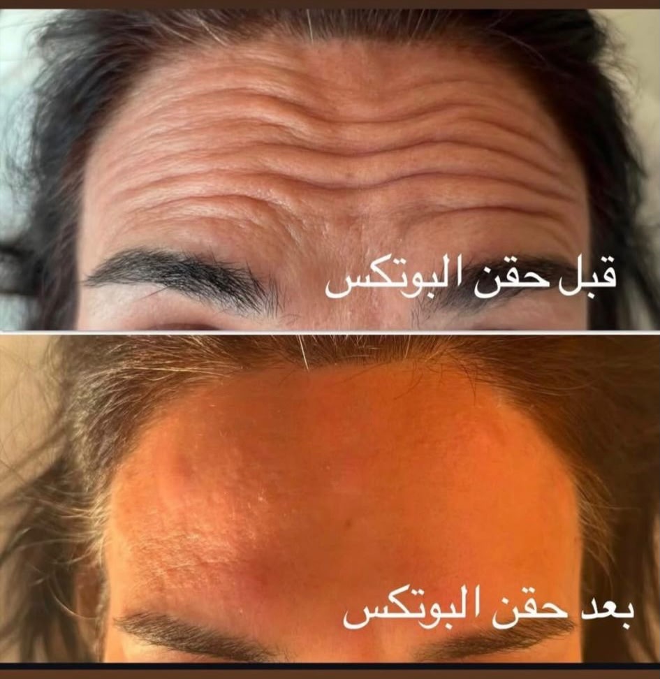 Vorher Nachher — Stirnfalten, Dr. Nour