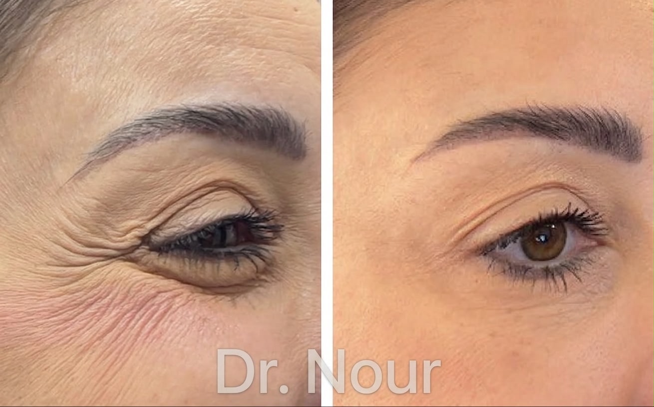 Vorher Nachher — Krähenfüße, Dr. Nour